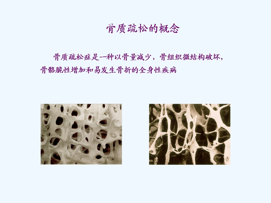 骨质疏松症及伊班膦酸钠的应用课件.ppt_第2页