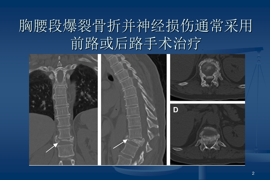 胸腰椎爆裂骨折的治疗课件.ppt_第2页