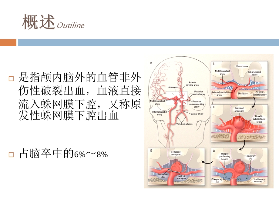 蛛网膜下腔出血的规范化诊治课件.ppt_第2页