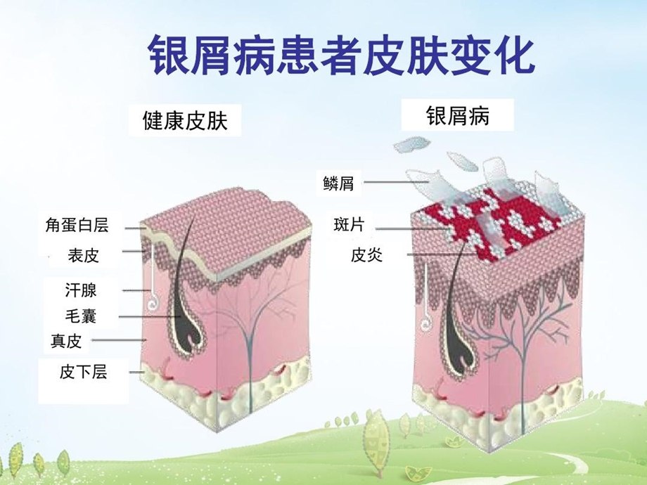 银屑病课件银屑病吧.ppt_第3页