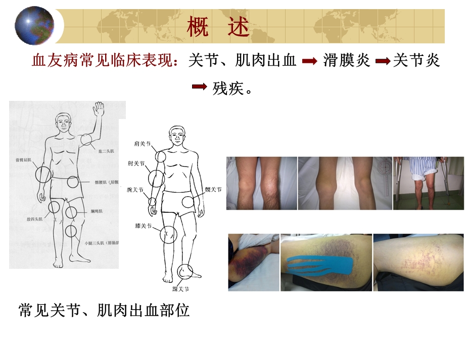 血友病关节肌肉出血后的康复治疗课件.ppt_第3页