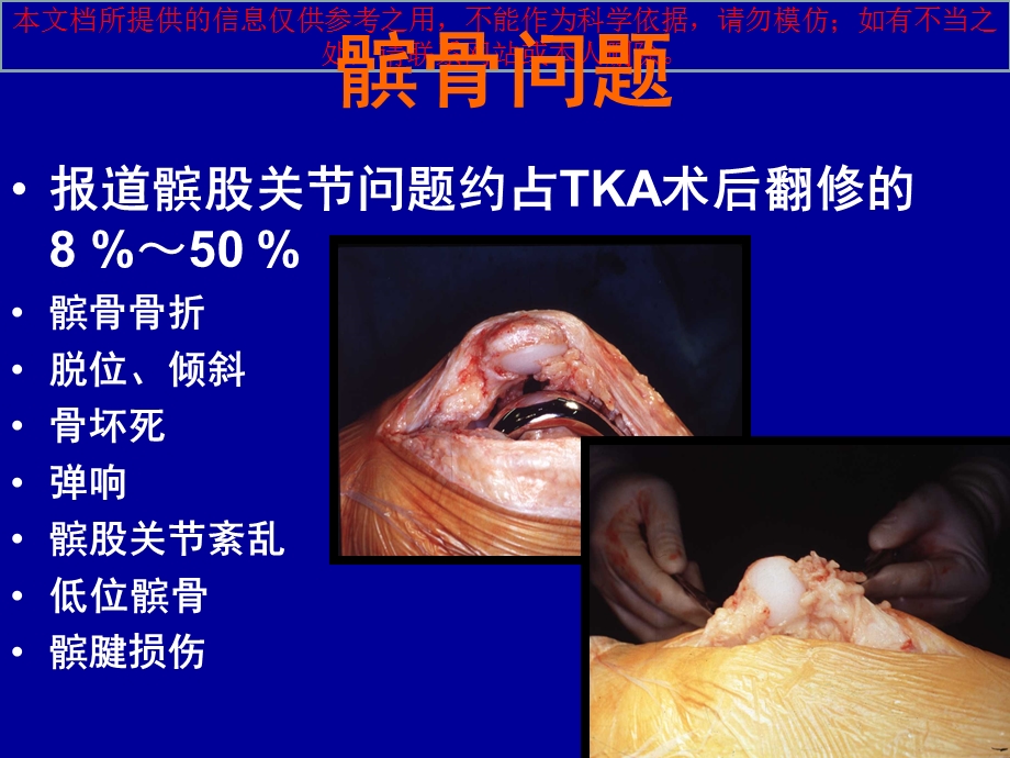 TKA术中髌骨的处置郑州医师会培训课件.ppt_第2页