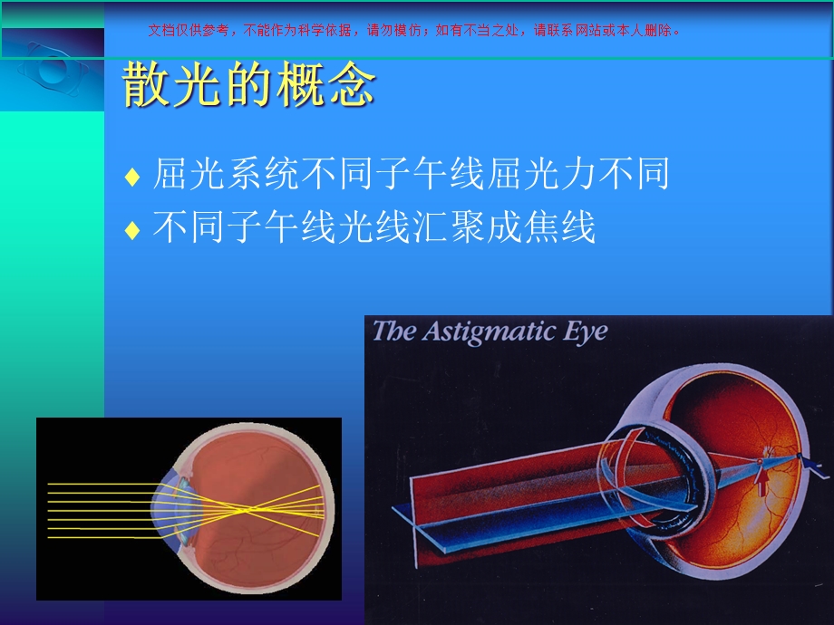 ToricICL植入矫正高度近视散光培训课件.ppt_第1页