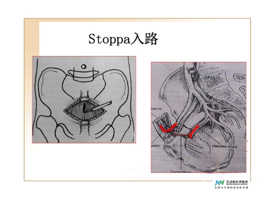 Stoppa入路相关知识讲解课件.ppt_第3页