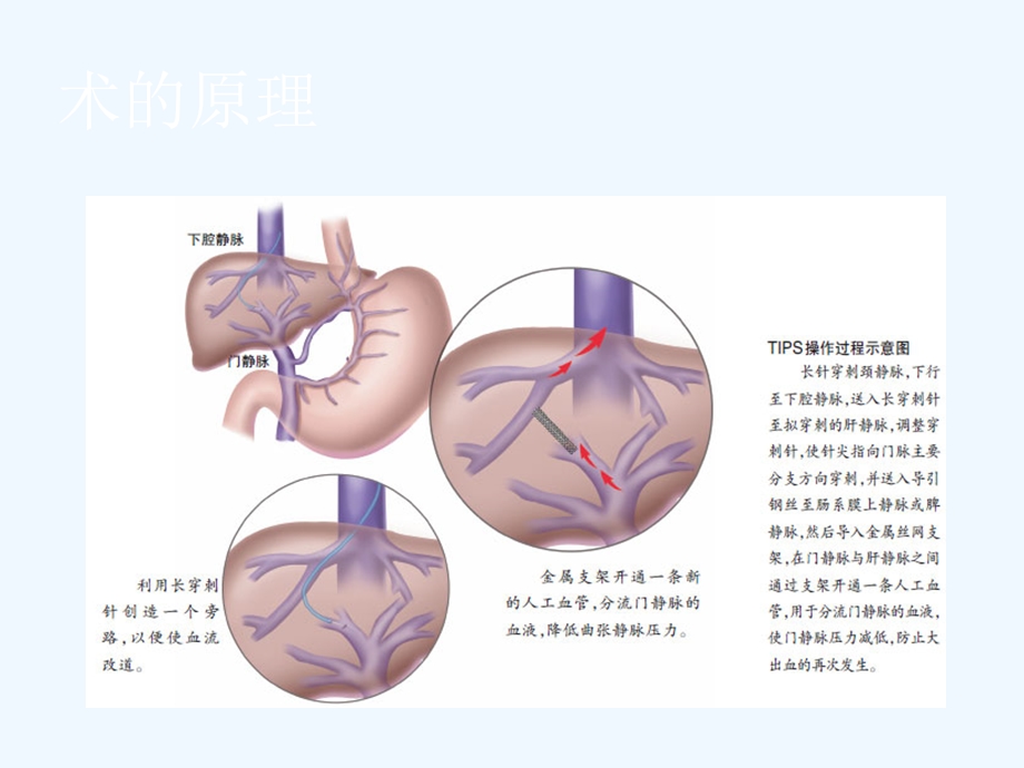 TIPS在门脉高压患者中的临床应用.ppt_第3页