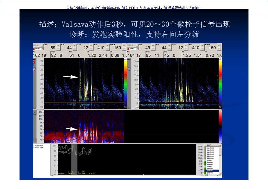 TCD发泡实验在神经内科疾病中应用的典型病例析课件.ppt_第3页