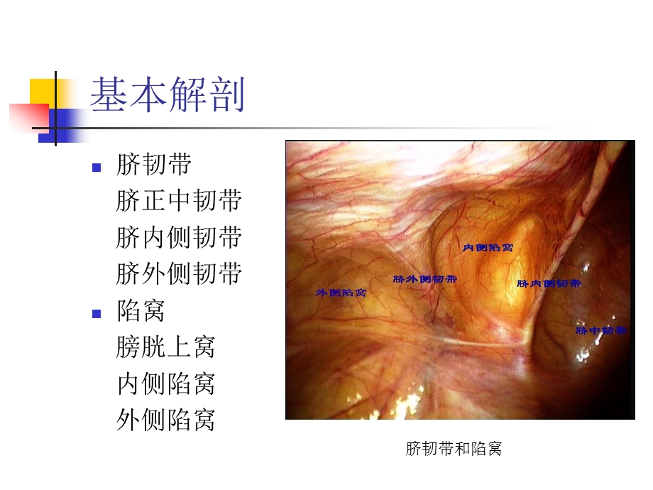 TAPP手术技巧课件.pptx_第3页