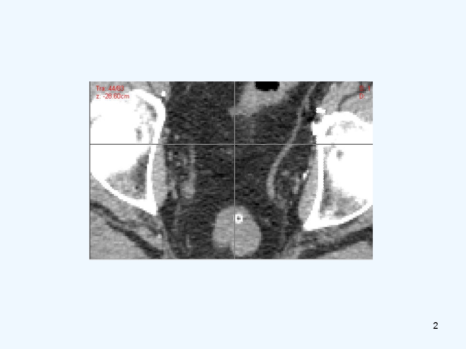 RTOG前列腺癌术后靶区勾画课件.ppt_第2页
