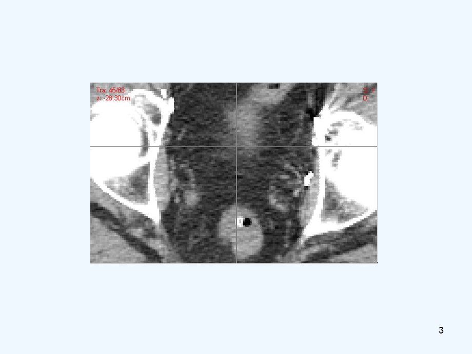 RTOG前列腺癌术后靶区勾画课件.ppt_第3页