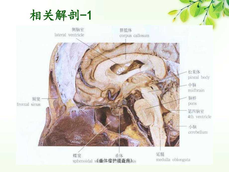 《垂体瘤护理查房》课件.ppt_第3页