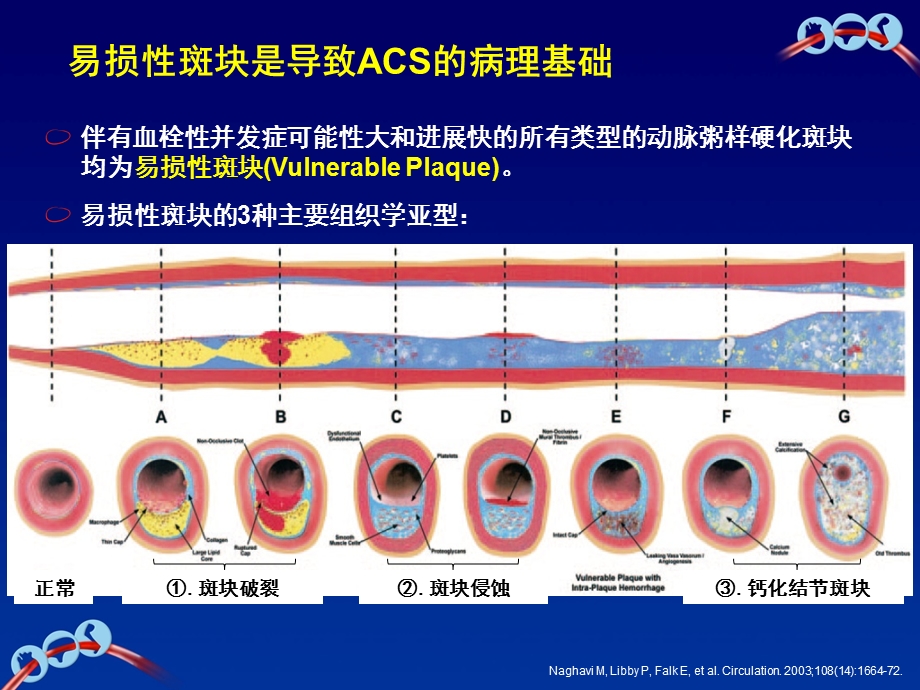 ACS疾病和长期抗血小板治疗的病理基础ppt课件.ppt_第3页