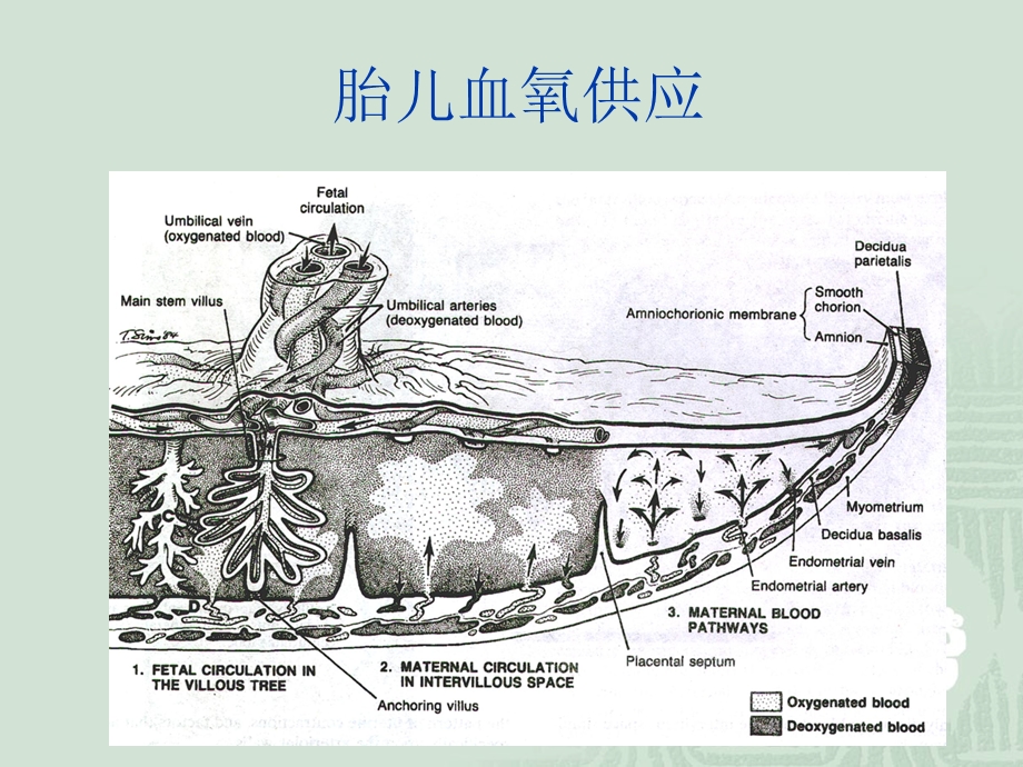 医学胎儿窘迫FetalDistress课件.ppt_第3页