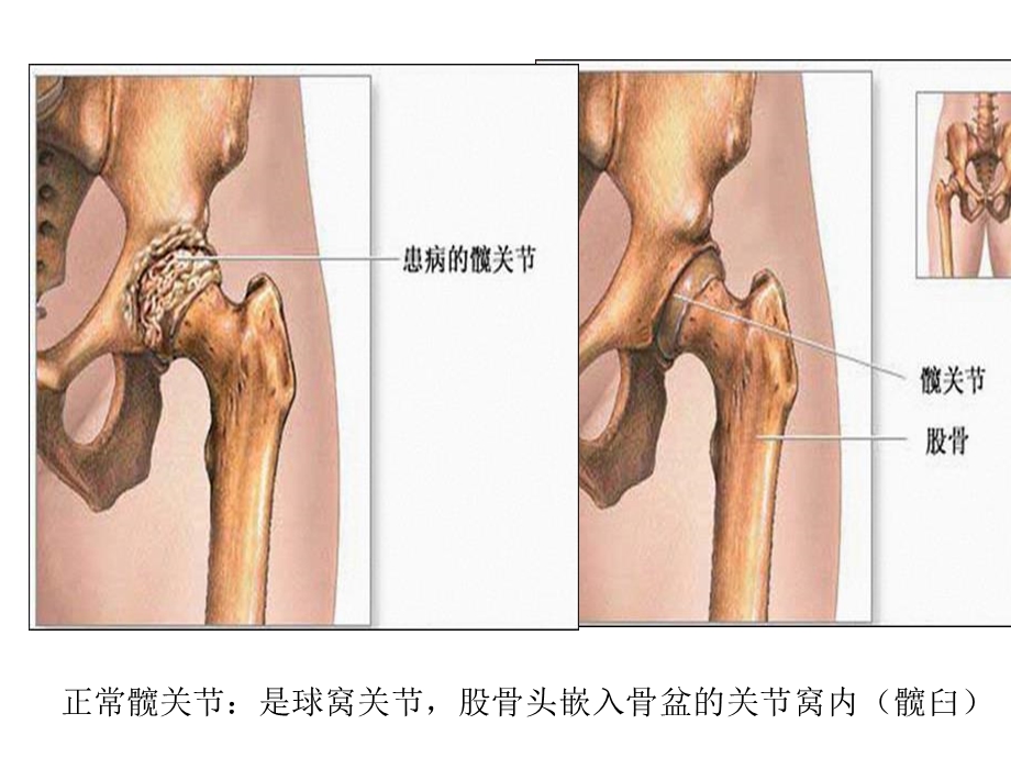 人工髋关节置换术后的护理进展(“髋关节”相关)共30张.pptx_第2页