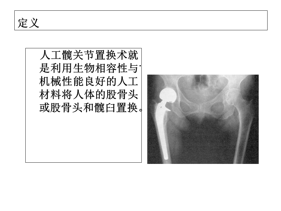 人工髋关节置换的护理2.ppt_第2页