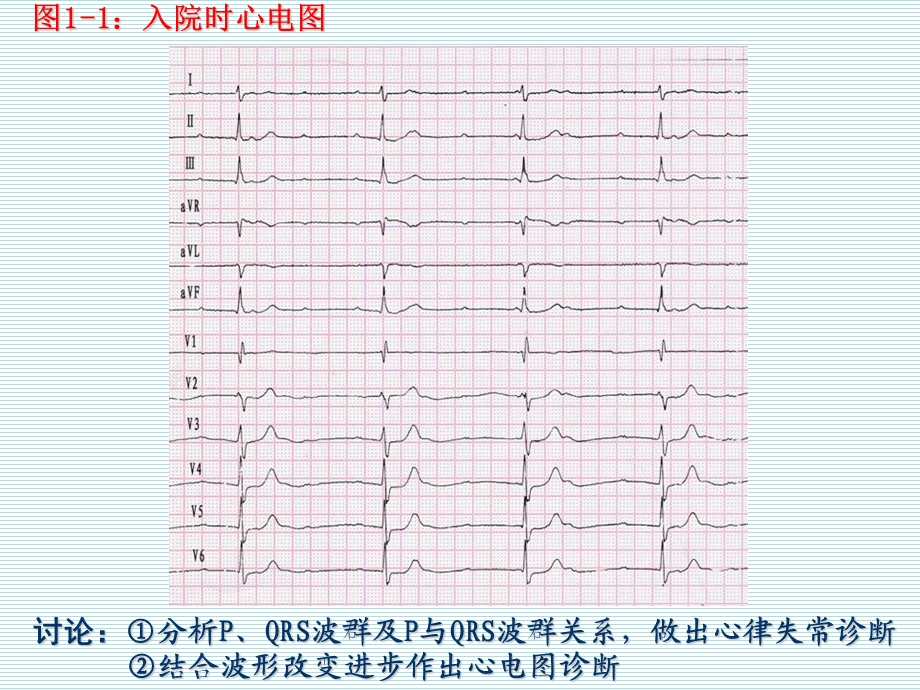 临床心电图病例讨论1房室分离课件.ppt_第3页