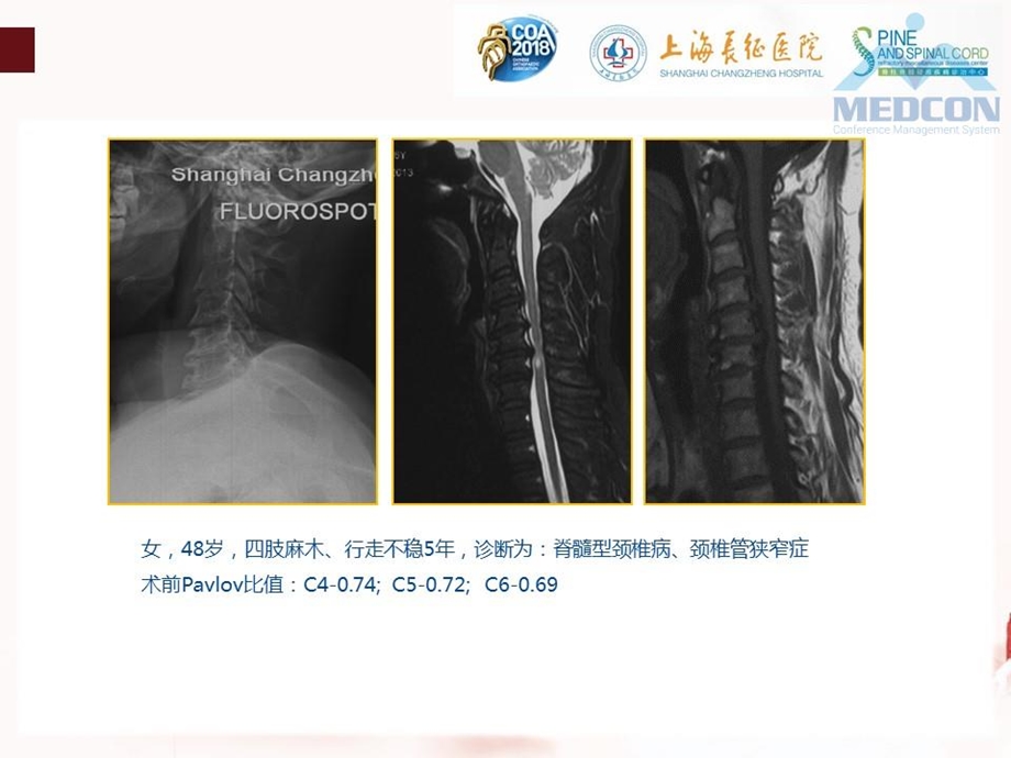 ACAF技术在颈椎管狭窄症治疗中的应用ppt课件.pptx_第3页