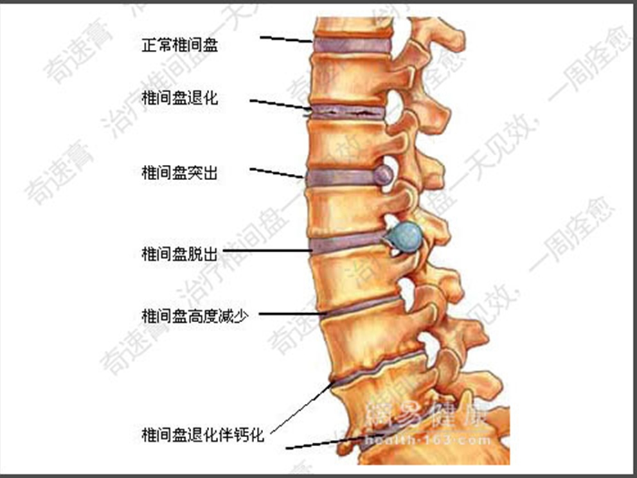 五节腰椎间盘突出症课件.pptx_第3页