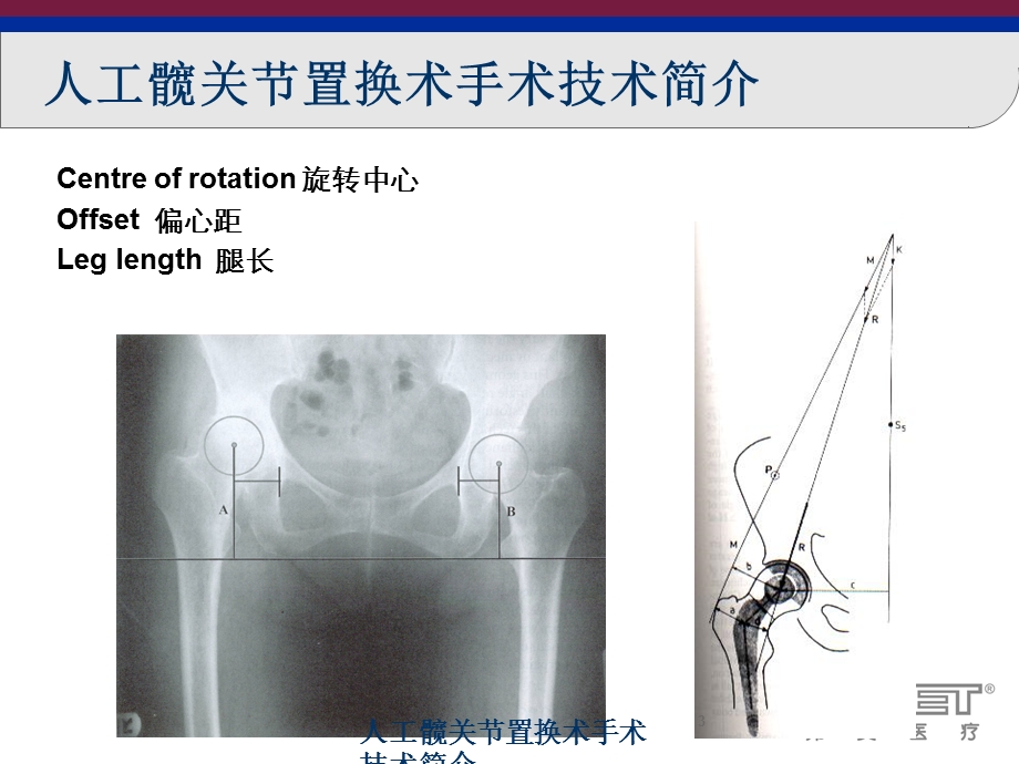 人工髋关节置换术手术技术简介培训课件.ppt_第3页