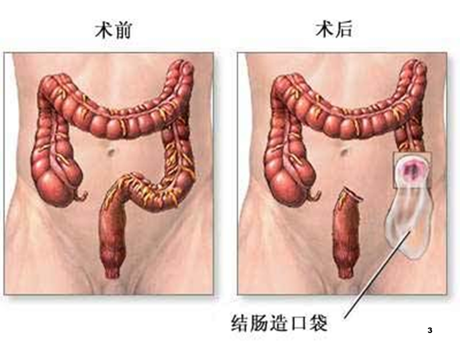 人工肛门的护理课件.pptx_第3页