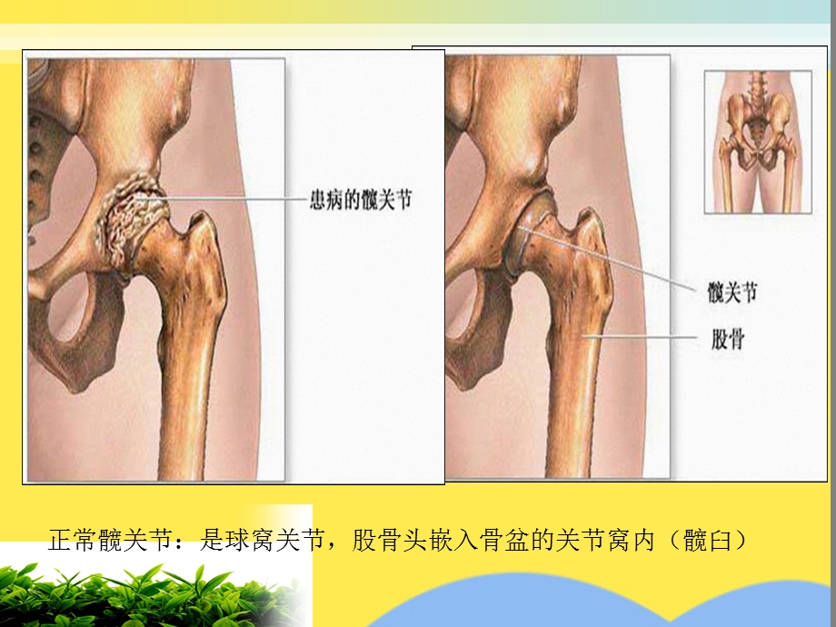 人工髋关节置换术后的护理进展(“髋关节”相关)共30张课件.pptx_第2页