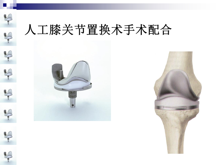 人工膝关节置换术手术配合课件.ppt_第1页