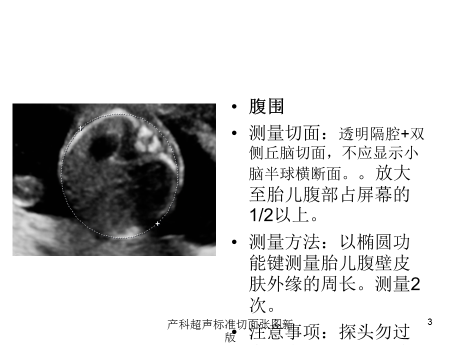 产科超声标准切面张图新版培训课件.ppt_第3页