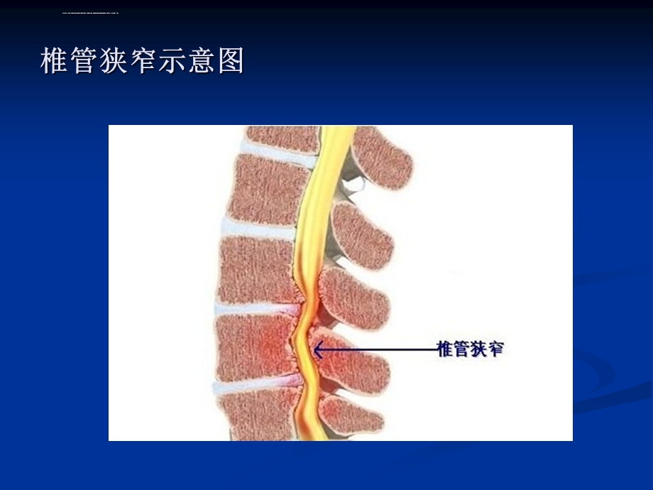 腰椎管狭窄症课件.ppt_第3页