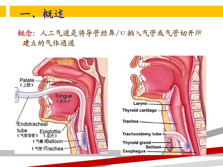 人工气道管理护理进展课件.ppt_第3页