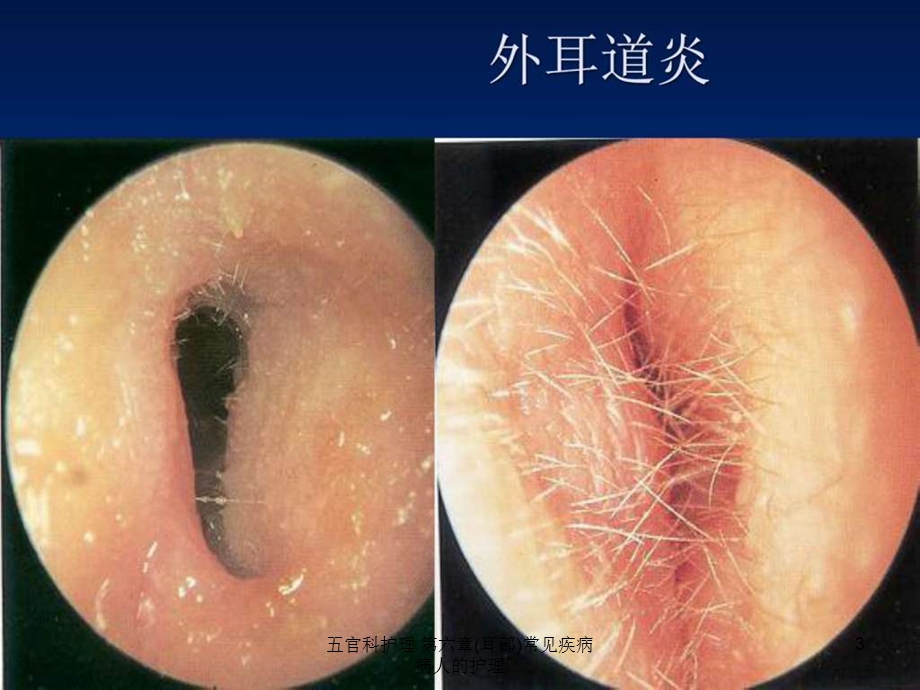 五官科护理第六章(耳部)常见疾病病人的护理课件.ppt_第3页