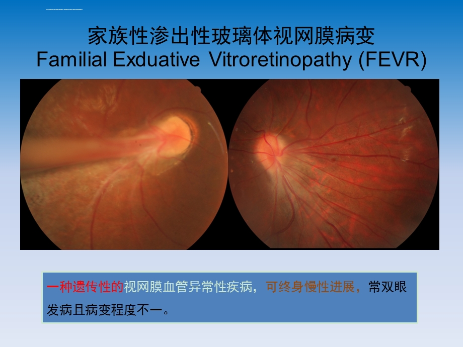 FEVR的治疗进展ppt课件.ppt_第2页