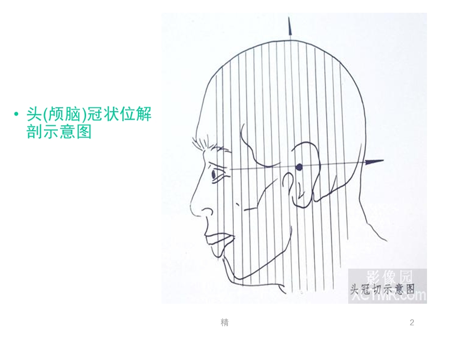 人体断层解剖图谱大脑头(颅脑)冠状位解剖示意图精选课件.ppt_第2页