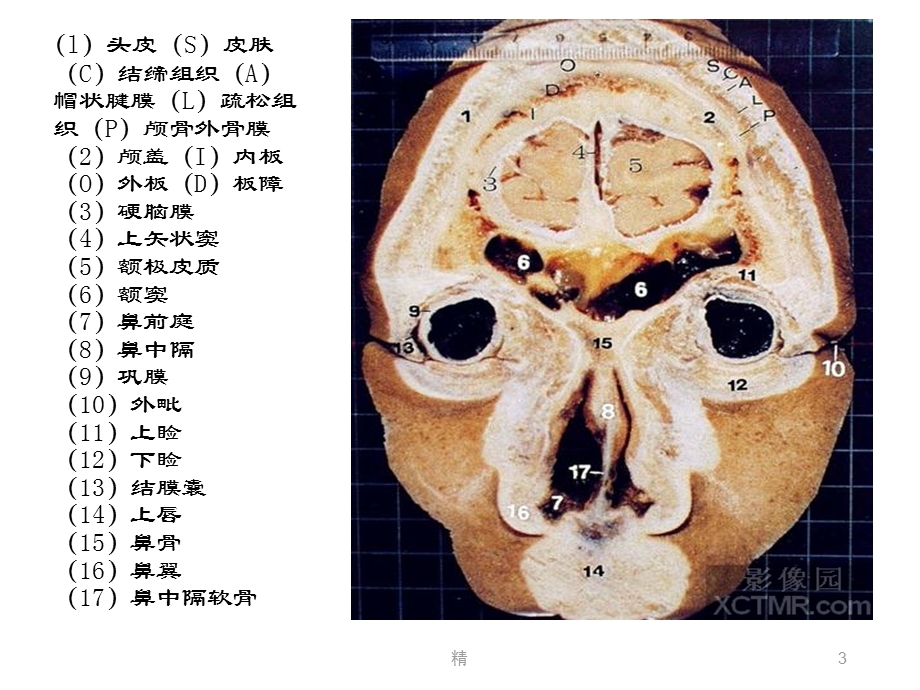 人体断层解剖图谱大脑头(颅脑)冠状位解剖示意图精选课件.ppt_第3页