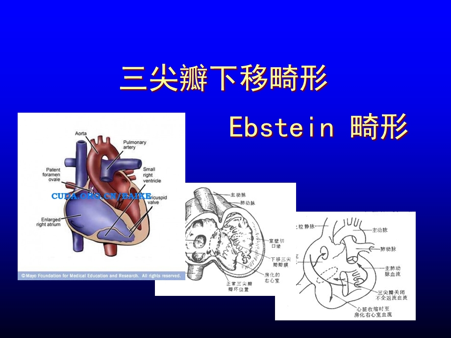 三尖瓣下移畸形 ebstein anomaly课件.ppt_第1页