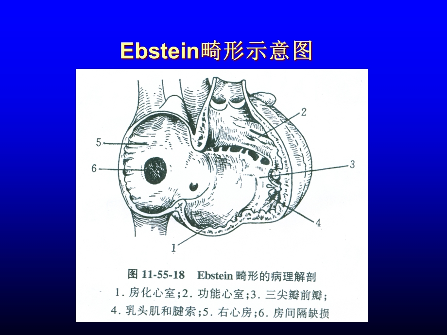 三尖瓣下移畸形 ebstein anomaly课件.ppt_第3页