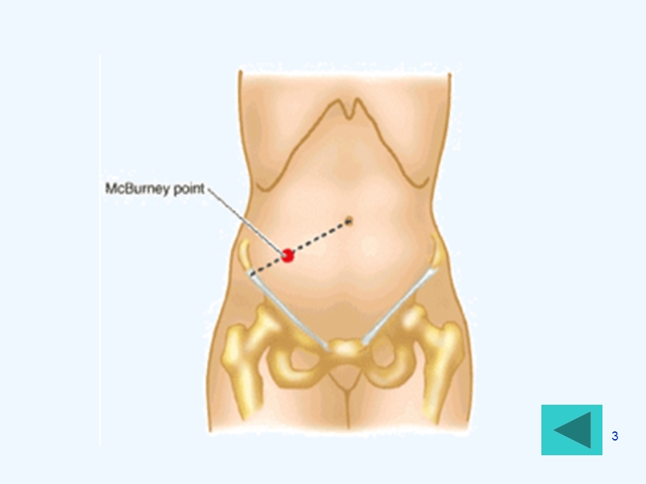 产褥期阑尾炎病人护理课件.ppt_第3页
