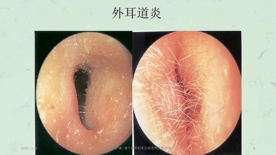 五官科护理第六章耳部常见疾病病人的护理课件.ppt_第3页