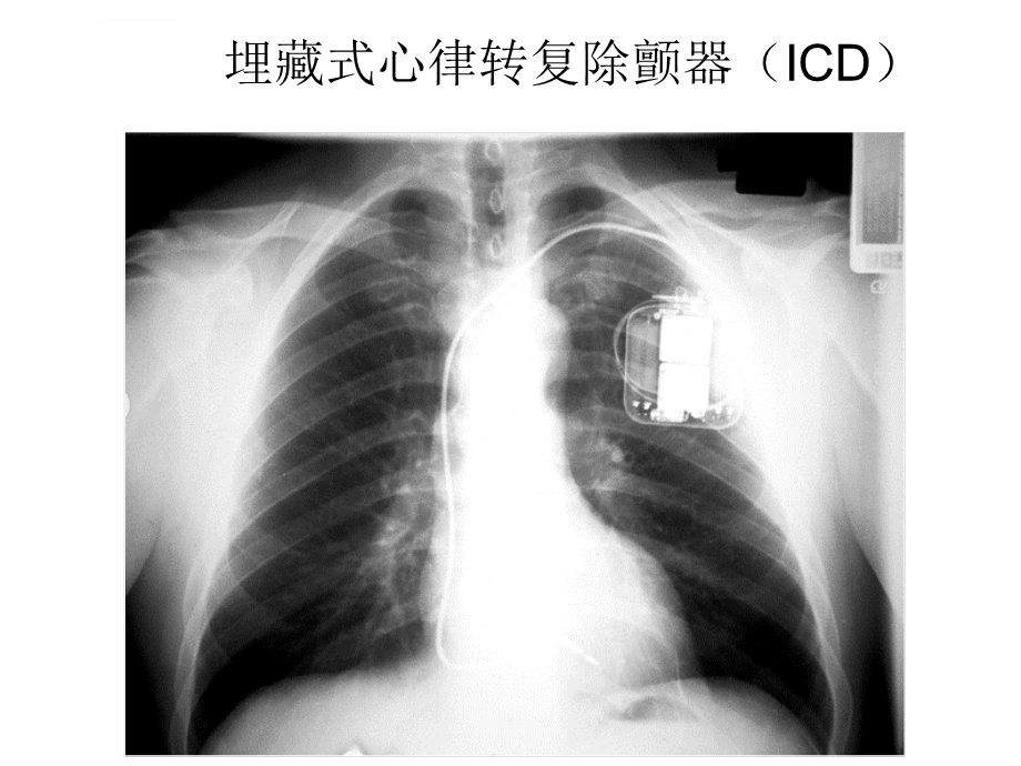 ICD术后抗心律失常药物的应用知识分享ppt课件.ppt_第3页