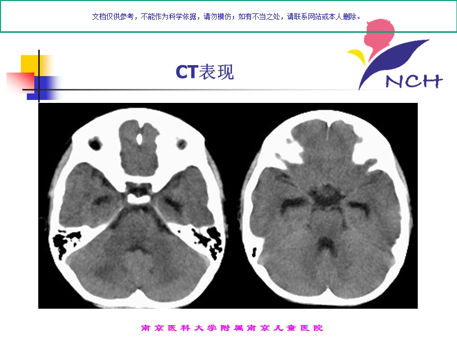 儿童坏死性脑病的CT诊疗课件.ppt_第3页