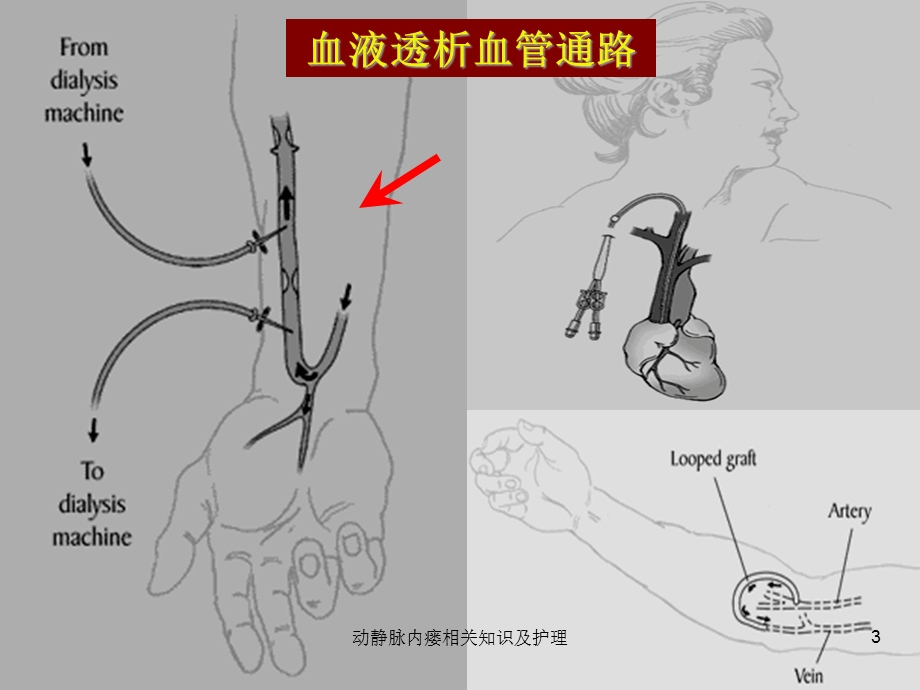 动静脉内瘘相关知识及护理课件.ppt_第3页