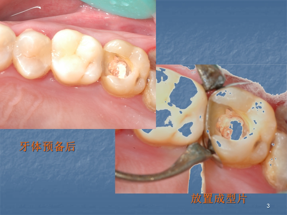 分段成型片的临床应用北大口腔参考课件.ppt_第3页