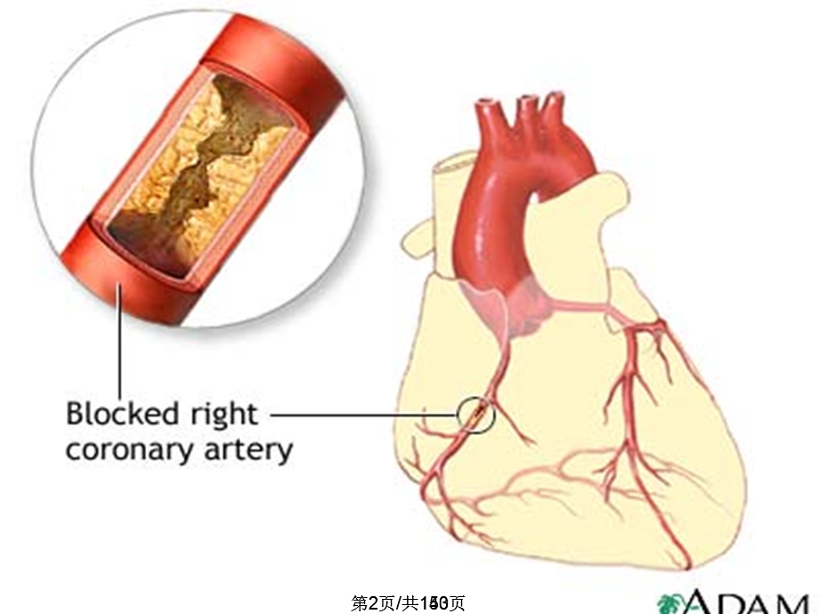 冠心病全面版课件.pptx_第2页