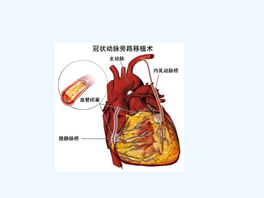 冠心病药物治疗课件.ppt_第3页