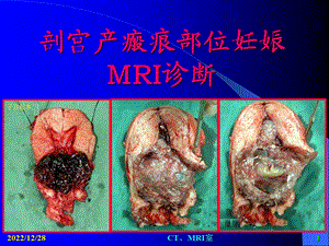 剖宫产子宫疤痕妊娠MRI课件.pptx