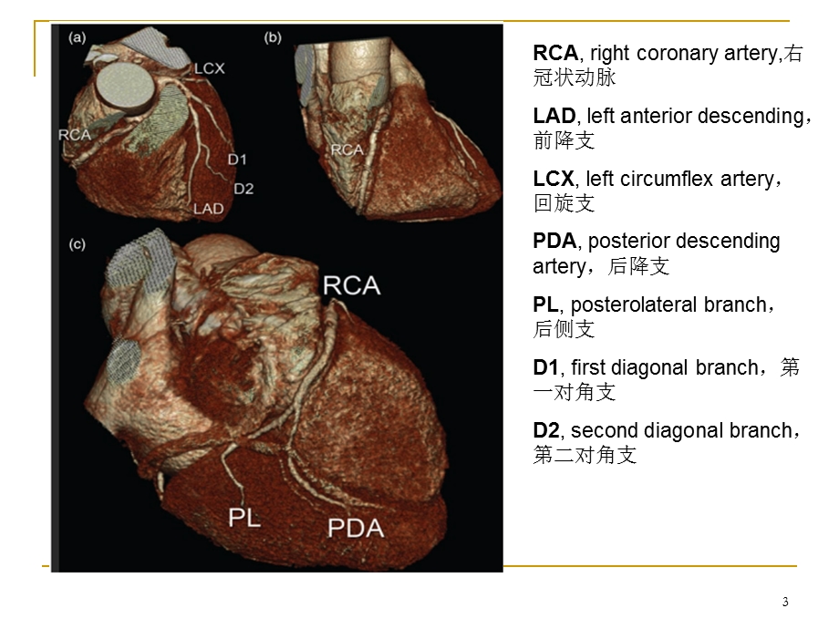 冠状动脉CTA图像判读学习课件.ppt_第3页
