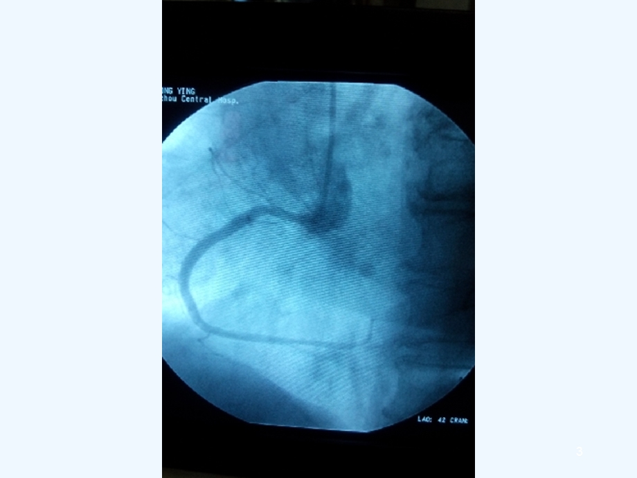 冠状动脉粥样硬化性心脏病介绍课件.ppt_第3页