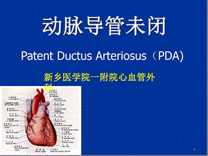 动脉导管未闭护理课件.ppt