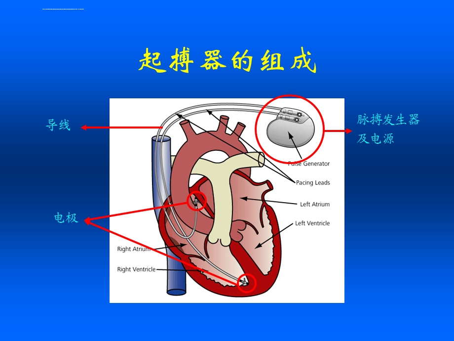 临时起搏器解读ppt课件.ppt_第3页