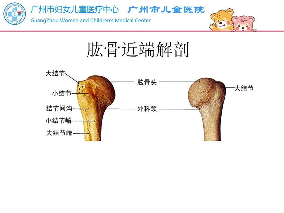 儿童肱骨近端骨折的治疗课件.ppt_第3页