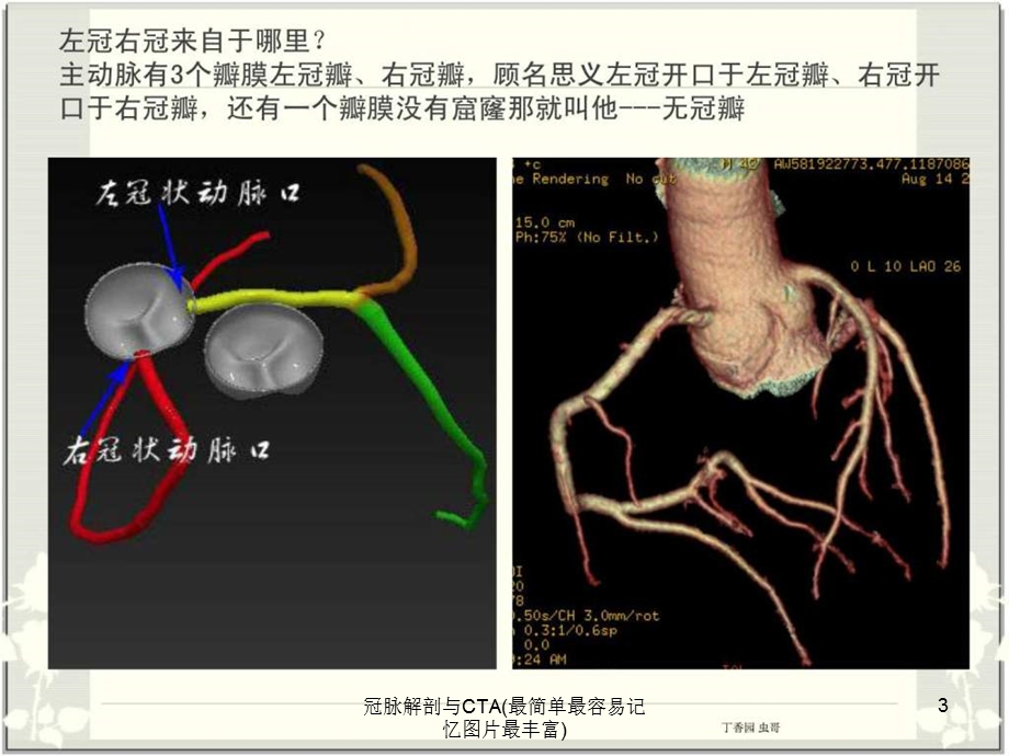 冠脉解剖与CTA(最简单最容易记忆图片最丰富)课件.ppt_第3页