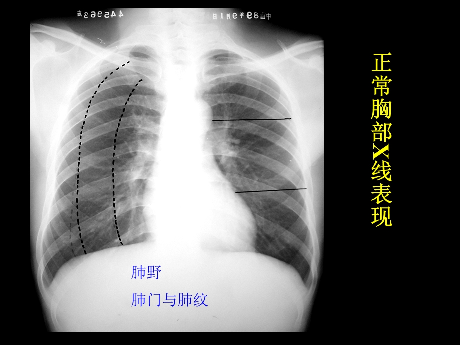 临床常见X光片解读ppt课件.ppt_第2页